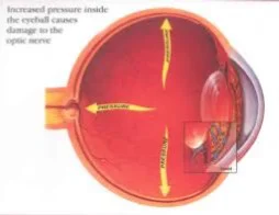 hhh-glaucoma /></noscript></p>
<p style=
